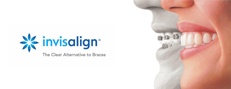Invisalign Clear Braces for Teeth
